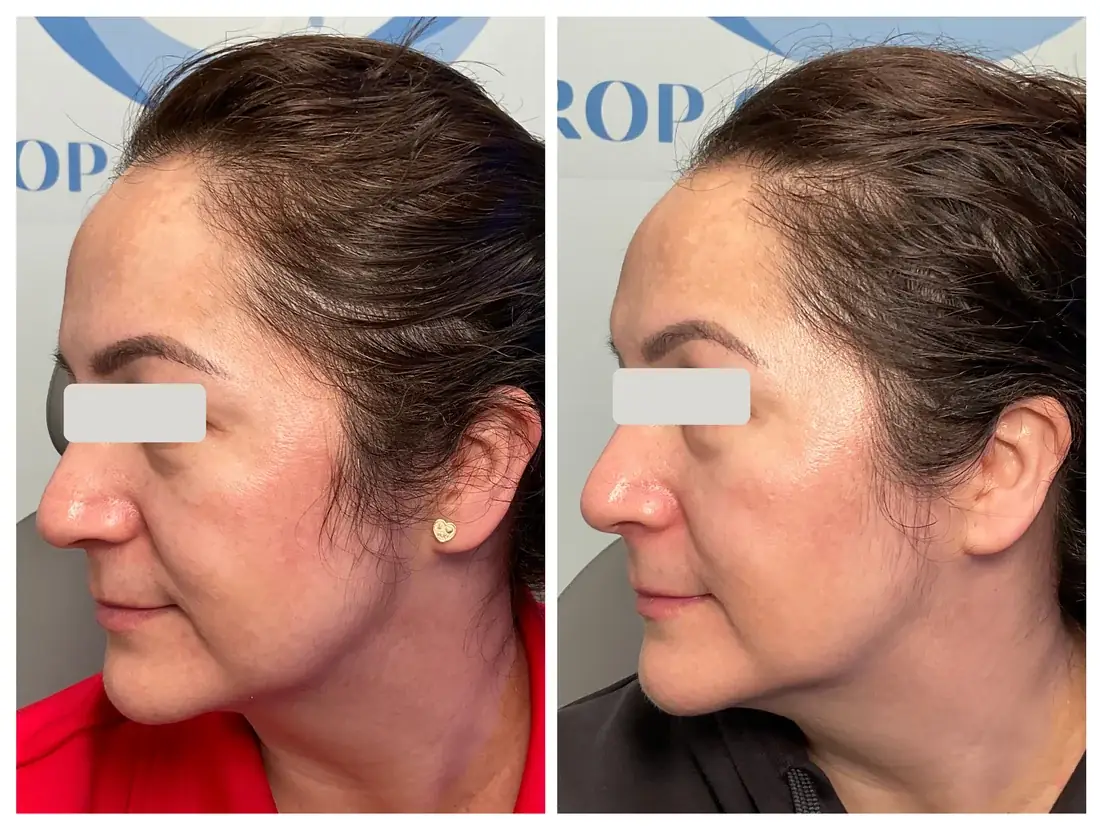 Láser CO2 CoolPeel antes y después en Drop of Paradise, El Cerrito CA — los resultados varían