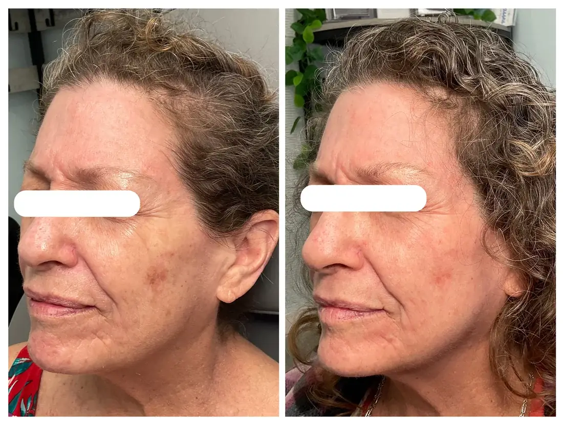 Rejuvenecimiento láser CO2 CoolPeel antes y después en Drop of Paradise, El Cerrito CA — los resultados varían