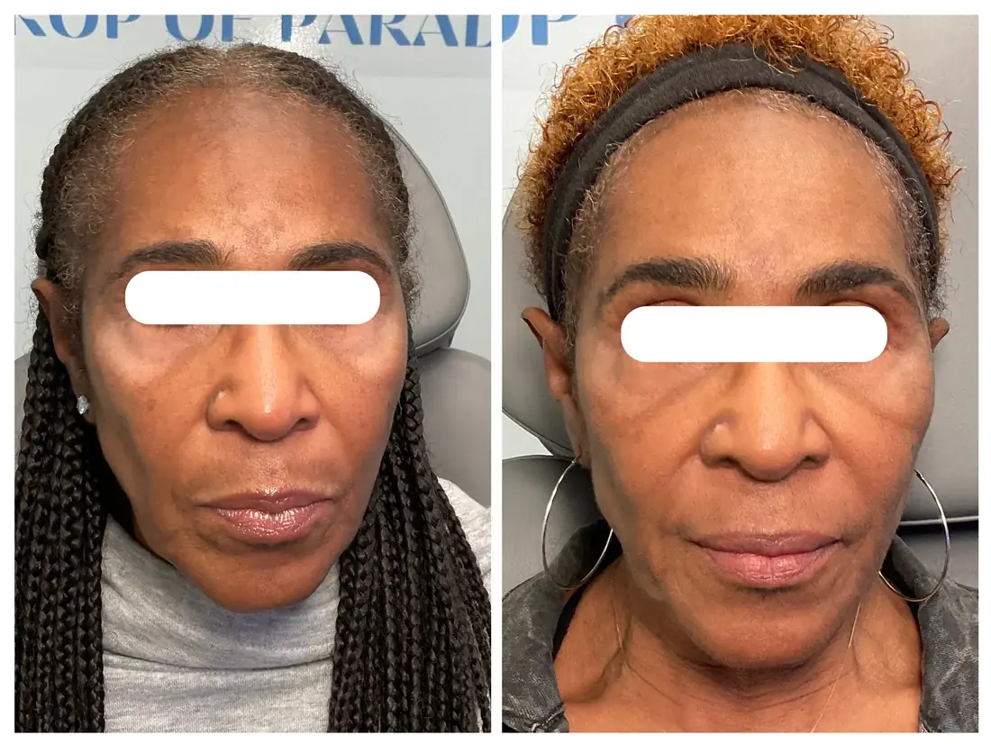 Láser CO2 CoolPeel DEKA antes y después en Drop of Paradise, El Cerrito CA — los resultados varían