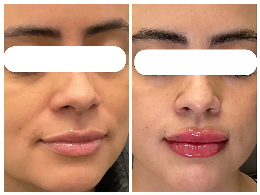 Relleno de labios antes y después en Drop of Paradise, El Cerrito CA — los resultados varían