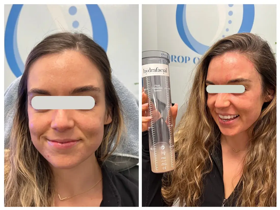 Hydraneedle (HydraFacial + microneedling) antes y después en Drop of Paradise, El Cerrito CA — los resultados varían
