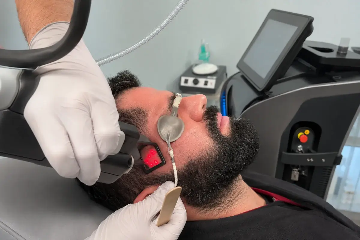 CoolPeel CO₂ laser resurfacing at Drop of Paradise in El Cerrito